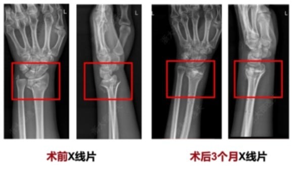 Bone-02, loại 'keo siêu dính' có thể chữa lành xương gãy chỉ trong vài phút- Ảnh 2. Ứng dụng Bone-02 trong y học